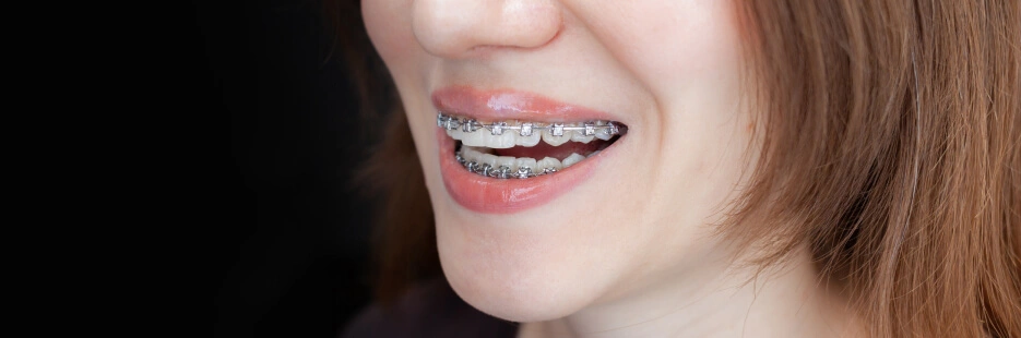 Ортодонтические аппараты: брекет системы