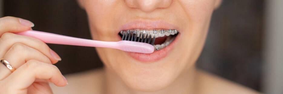 Переваги брекетів